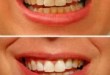 Diş estetiği ile diş beyazlatma