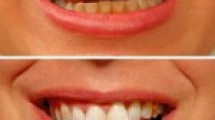 Diş estetiği ile diş beyazlatma