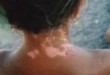 Vitiligo