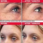 BOTOX - Botoks