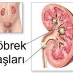 Böbrek Taşı 