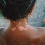 Vitiligo