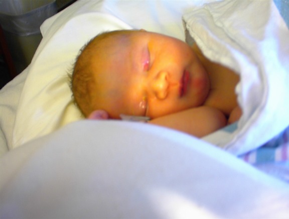 Yeni doğan Bebekte Sarılık